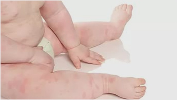 сыпь по всему телу