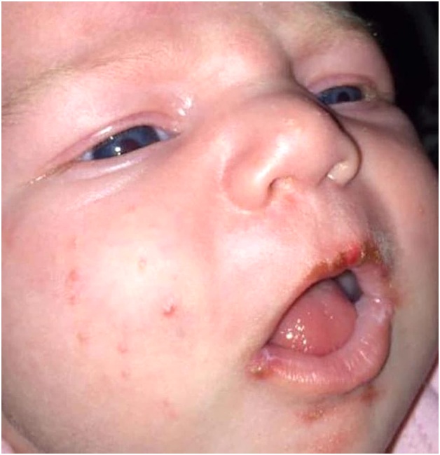 язвы на губах