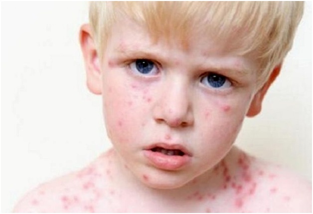 сыпь на лице и шее