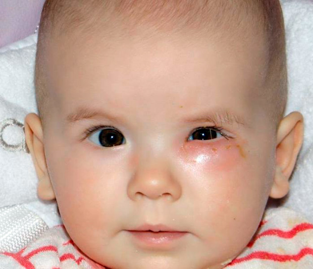 Дакриоцистит