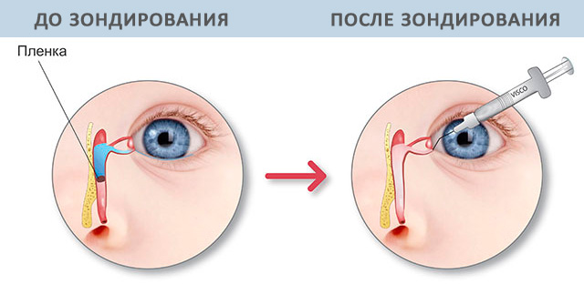 зондирование слезного канала