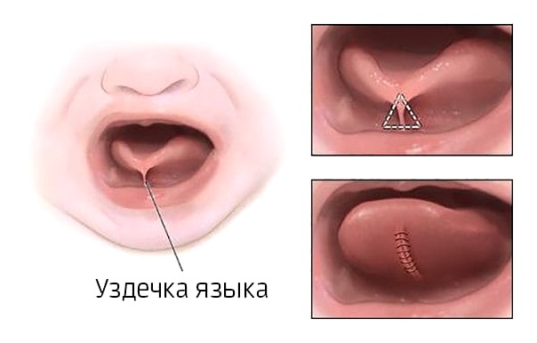 как надрезают