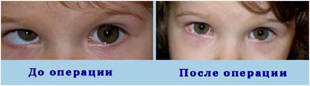 до и после операции