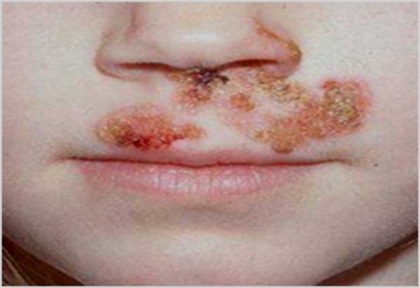 вавки под носом