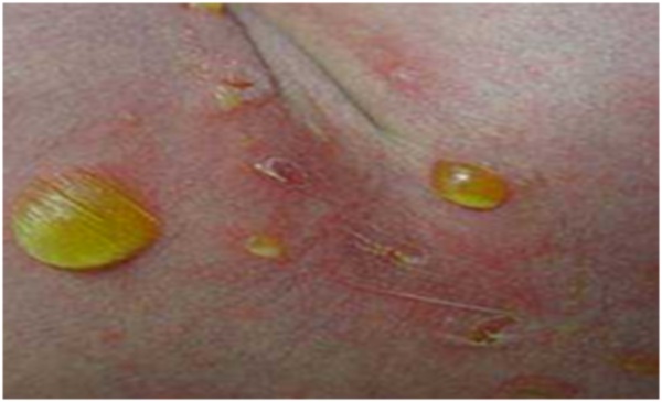 маленькие гнойнечки