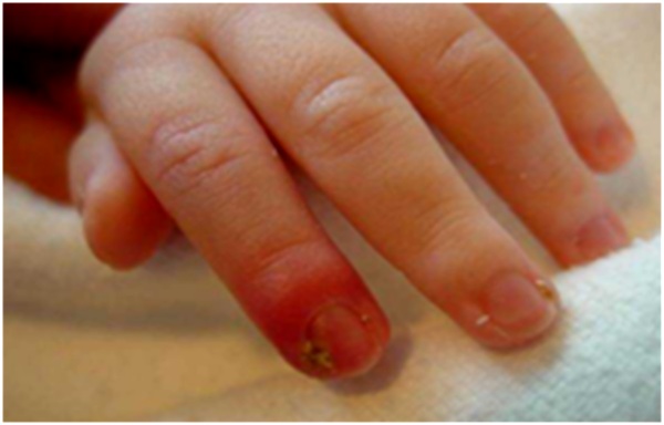 больной пальчик