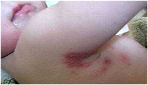 ранки подмышкой