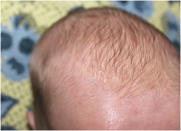 леп под волосами