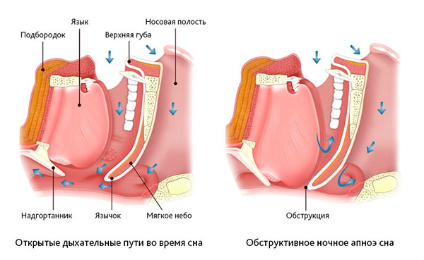 Лечение апноэ сна