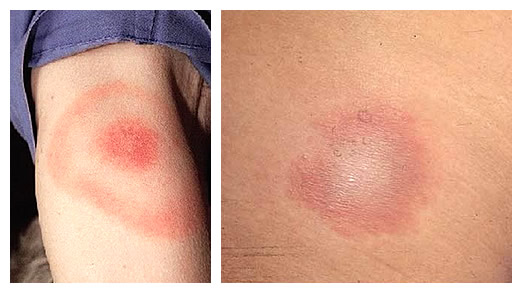 Симптомы первой стадии