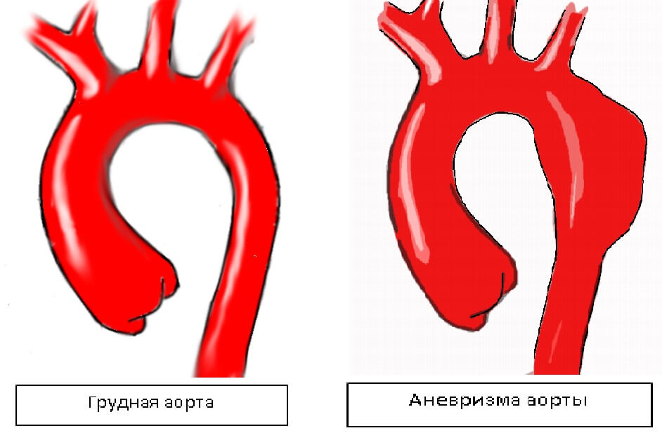 aorta