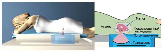 10505129-fuz-ablyaciya-prostata