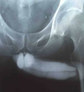 Кавернозогр