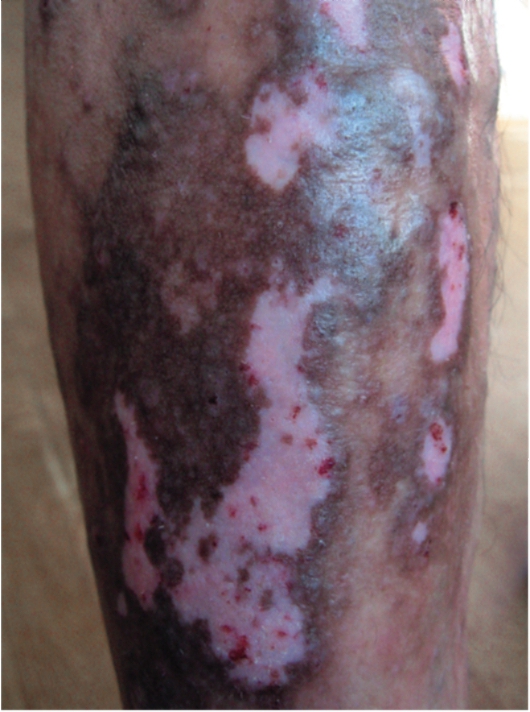 Симптомы атипичных форм