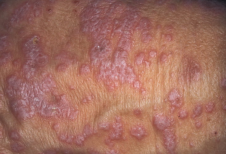 Симптомы типичной формы