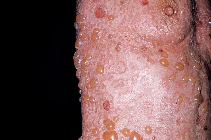 1298800363_pemfigoid_bulleznii_98-a-foto