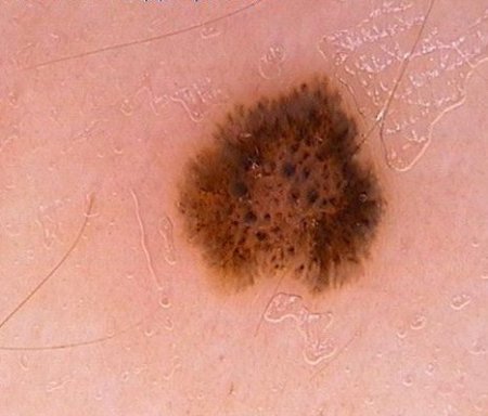 Naevus Corniculatus