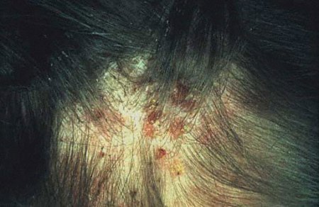 Головной педикулез