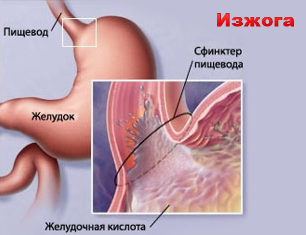 Причины изжоги