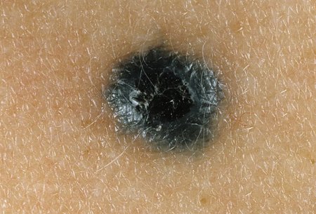 Клеточный голубой невус,