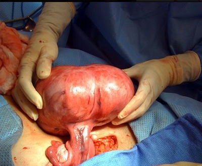 1402256324_kanser-perut-2