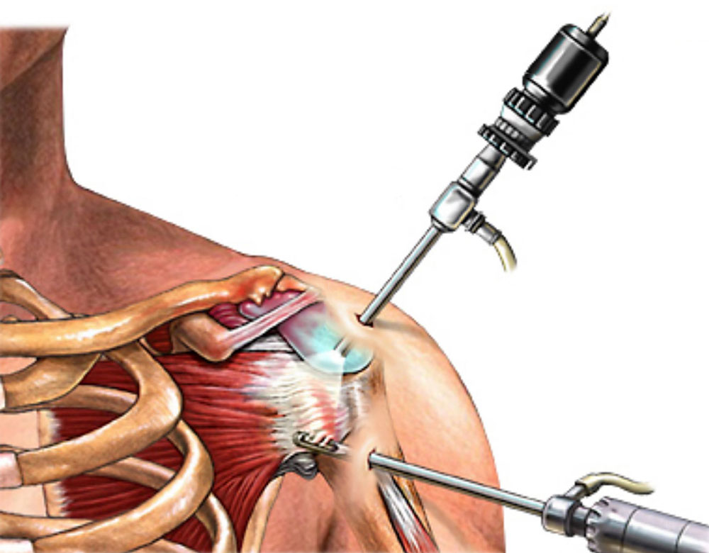 операция при бурсите