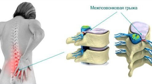 mediannaya-gryzha-diska-simptomy-lechenie-1