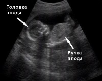 УЗИ в 10-14 недель