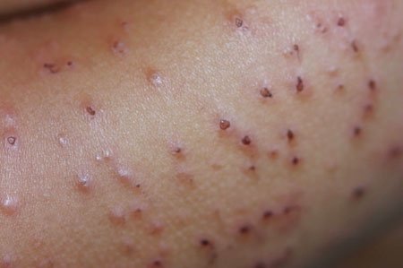 Почесуха Бенье.