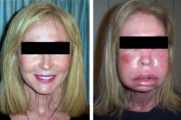 20140513_Alergia Angioedema_1