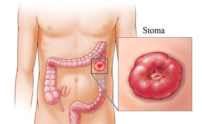 stoma-gemoroy