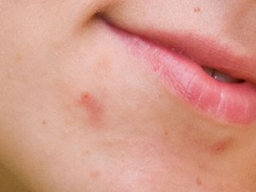 gemorragicheskiy-laringit-prichiny-simptomy-lechenie