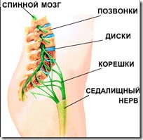 Причины защемления седалищного нерва