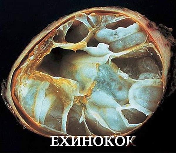 4 -эхинококк