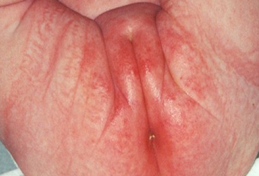 Половой дерматит.