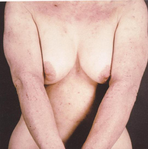 atopicheskiy dermatiti