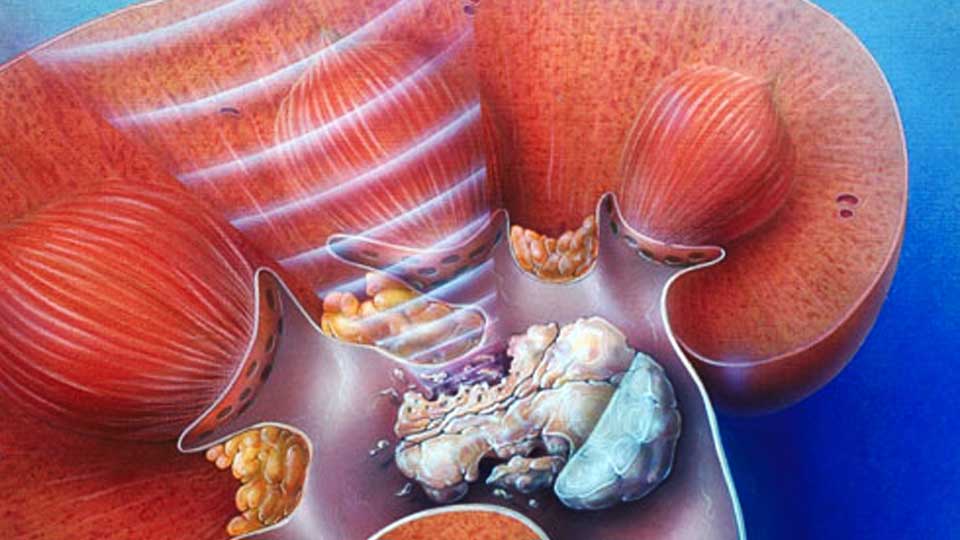 Камни в почках