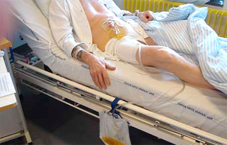 posle-udaleniya-mochevogo-puzyrya