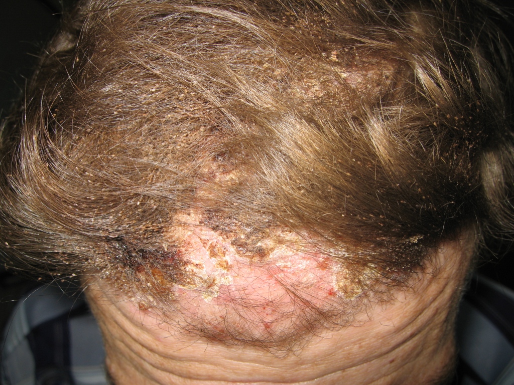 9.-vshivost-gnidy-e-kzematizatsiya