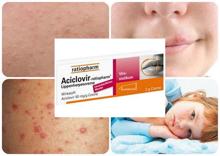 aciklovir-ot-gerpesa-i-vetryanki