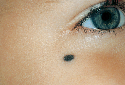 Простой голубой невус