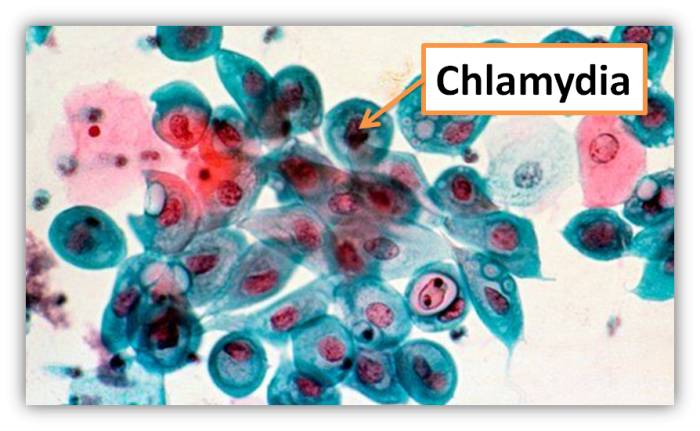 Chlamydia-Bacteria
