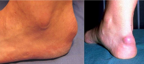 Диагностика бурситов