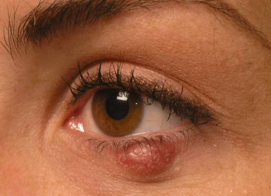 Причины халязиона