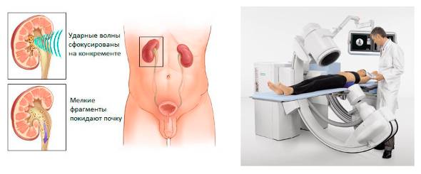 Дробление камней в почках