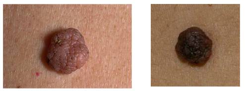 Внутридермальный невус кожи