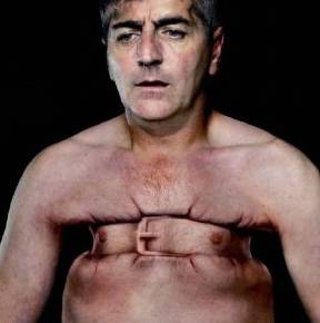 ипохондрии