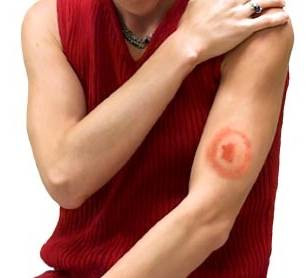 Симптомы болезни Лайма