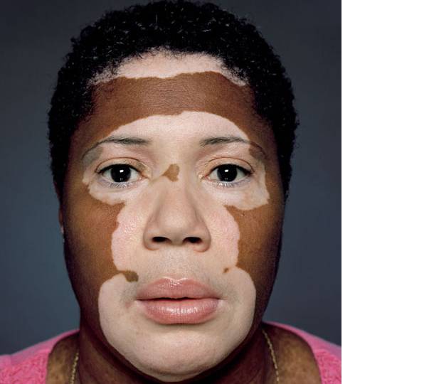 Как лечить витилиго?