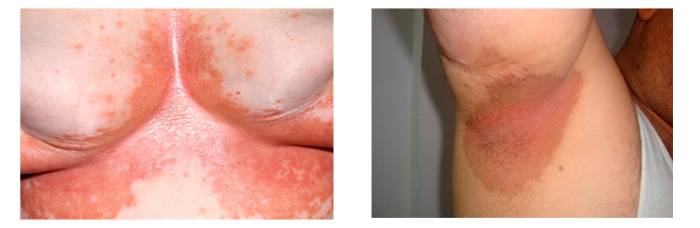 Эритразма – лечение и профилактика поверхностного псевдомикоза